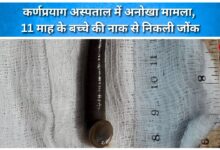 A unique case in Karnaprayag hospital, a leech was removed from the nose of an 11-month-old child.